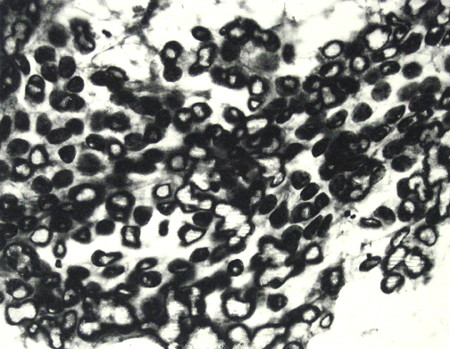 Cancer Cells Part 1